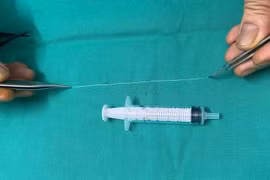 Gắp con giun dài 14 cm khỏi mắt bệnh nhân 68 tuổi