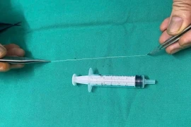 Gắp con giun dài 14 cm khỏi mắt bệnh nhân 68 tuổi