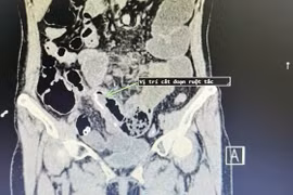 Đau bụng, nôn... đi khám phát hiện dính ruột, bệnh biến chứng nguy hiểm