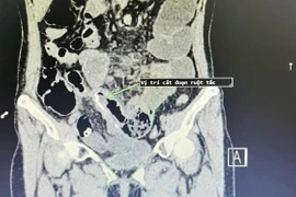 Đau bụng, nôn... đi khám phát hiện dính ruột, bệnh biến chứng nguy hiểm