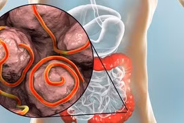 Phát hiện gần 30 con giun móc còn sống làm ổ trong dạ dày