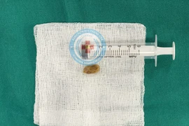 Cứu sống bé 10 tháng tuổi suy hô hấp do hóc dị vật 