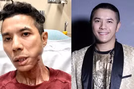 Kasim Hoàng Vũ phải cắt bỏ toàn bộ xương hàm, vẫn chưa phẫu thuật