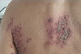 Liệt mặt, liệt chi, viêm não do zona thần kinh