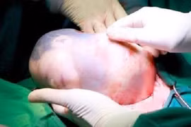 Hai bé song sinh chào đời, 1 bé còn nguyên trong “bọc điều” 