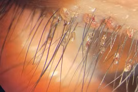 Phát hoảng rận bám chi chít trên mi mắt người phụ nữ 46 tuổi