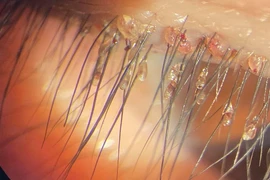 Phát hoảng rận bám chi chít trên mi mắt người phụ nữ 46 tuổi