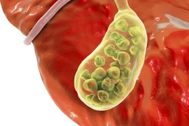 Cắt túi mật có ảnh hưởng đến sức khỏe?