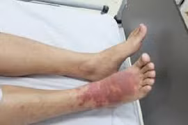 Suy đa phủ tạng sau giết mổ lợn, cách phòng tránh liên cầu lợn