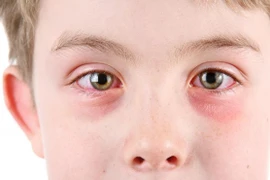 4 bệnh mắt thường gặp vào mùa mưa