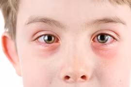 4 bệnh mắt thường gặp vào mùa mưa