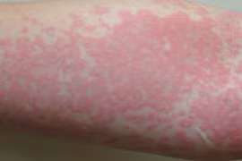 Dị ứng, mày đay có phải do suy giảm chức năng gan?