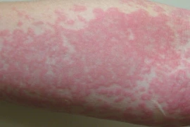 Dị ứng, mày đay có phải do suy giảm chức năng gan?