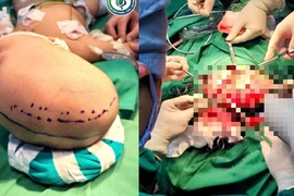 Mới 6 tháng tuổi đã xuất huyết não, hôn mê vì đột quỵ