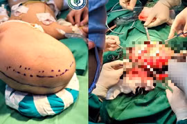 Mới 6 tháng tuổi đã xuất huyết não, hôn mê vì đột quỵ