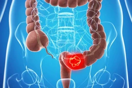 Dấu hiệu cảnh báo nguy cơ ung thư đại tràng