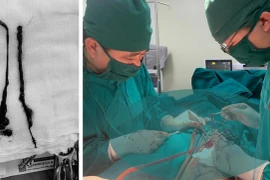 Đau chân, đi khám phát hiện tắc động mạch chậu đùi cấp