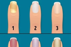 Dấu hiệu trên móng tay cảnh báo cơ thể thiếu vitamin quan trọng