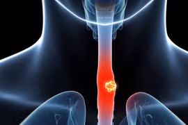 Người đàn ông nuốt nghẹn, nổi hạch cổ, đi khám phát hiện ung thư 