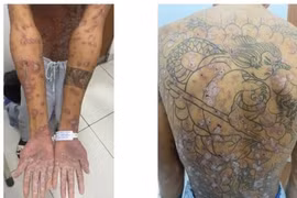 Điều trị thành công ca bệnh da hiếm gặp thứ 10 trên thế giới