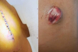 Bị mụn nhọt nên xử lý thế nào tránh biến chứng nguy hiểm?