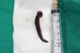 Đỉa sống dài hơn 5 cm nằm trong khí quản bệnh nhân 65 tuổi