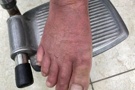 Cách chăm sóc, phòng tránh bệnh da và nguy cơ bỏng mùa bão lũ