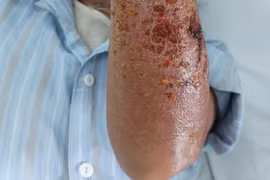 Cụ ông mắc căn bệnh nhiễm trùng nguy hiểm sau khi bị mèo cào