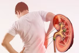 Bỏ thuốc điều trị tim, người đàn ông bị nhồi máu thận