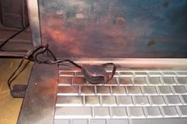 Bé trai 8 tuổi bị bỏng nặng do laptop phát nổ 