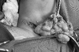 Phẫu thuật thành công khối u mỡ "khổng lồ" cho bé 6 tháng tuổi