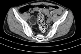 Điều trị thành công ca viêm não tự miễn hiếm gặp