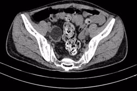 Điều trị thành công ca viêm não tự miễn hiếm gặp