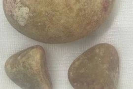 Bí tiểu, người đàn ông đi khám phát hiện “núi sỏi khổng lồ“