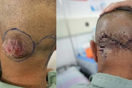 Phẫu thuật Mohs điều trị thành công hai ca ung thư da kích thước lớn 