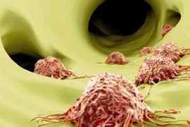 Chuyên gia chỉ cách điều trị ung thư di căn