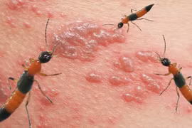 Cách đơn giản xử lý độc khi bị kiến ba khoang cắn 