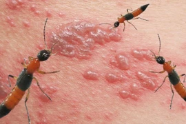 Cách đơn giản xử lý độc khi bị kiến ba khoang cắn 