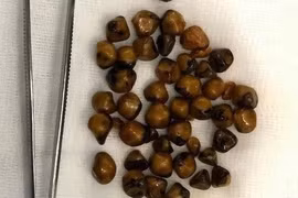 Người phụ nữ 51 tuổi có hơn 40 viên sỏi trong túi mật 