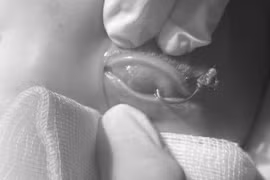 Đi câu cá, bé trai ở Nghệ An bị lưỡi câu găm vào mắt