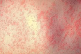 Nguyên nhân khiến dịch sởi bao trùm châu Âu