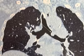 Cắt nối, tạo hình phế quản thành công cho bệnh nhân ung thư phổi