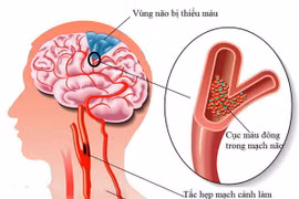 Dấu hiệu của thiếu máu não, đừng chủ quan đột quỵ như chơi