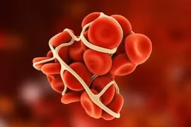 Những người dễ mắc chứng bệnh cục máu đông, phòng ngừa thế nào?