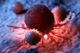 Phương pháp mới chống ung thư không cần thuốc, không xâm lấn