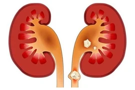 Người đàn ông bị sốc nhiễm khuẩn, thận ứ mủ do sỏi niệu quản