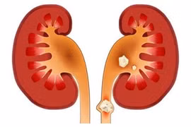 Người đàn ông bị sốc nhiễm khuẩn, thận ứ mủ do sỏi niệu quản