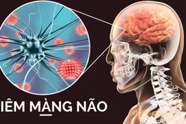 Viêm màng não do viêm tai giữa kéo dài nhiều năm