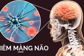 Viêm màng não do viêm tai giữa kéo dài nhiều năm