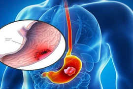 Viêm mạn tính gây ung thư, làm thế nào để tránh?